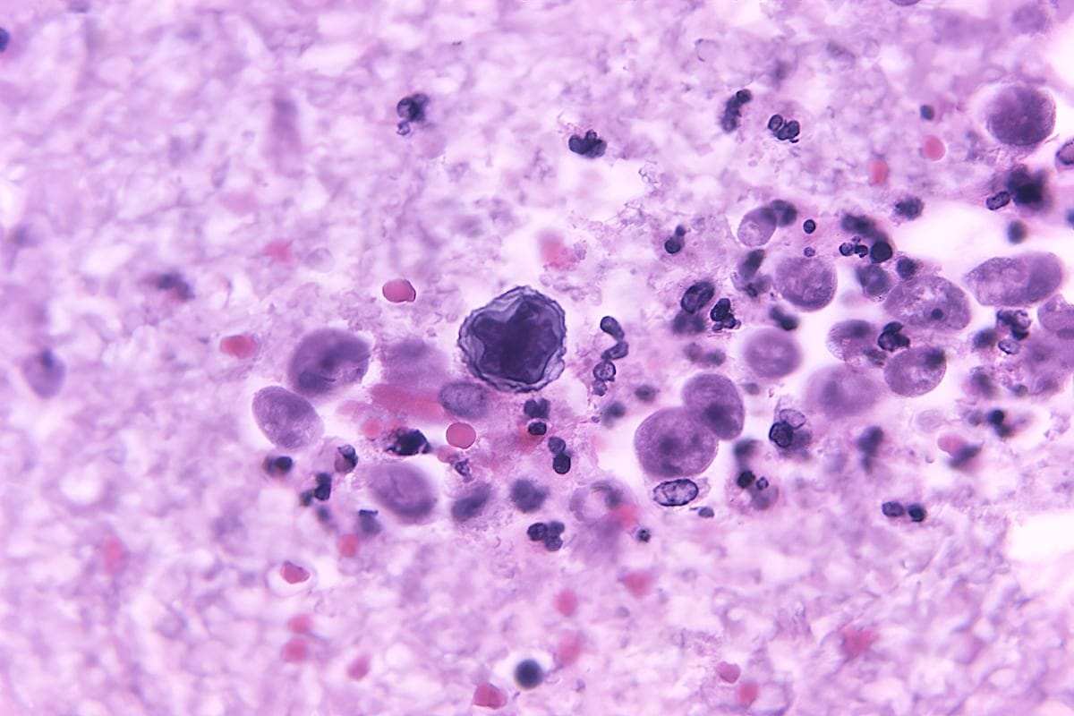 Primer caso mortal de Naegleria fowleri en Yucatán: instructor de wakeboard fallece por meningitis amebiana
